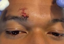 إصابة مبابي