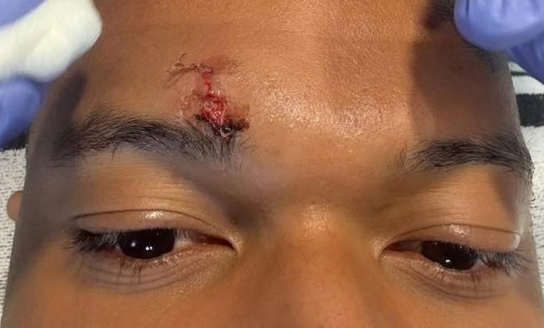 إصابة مبابي