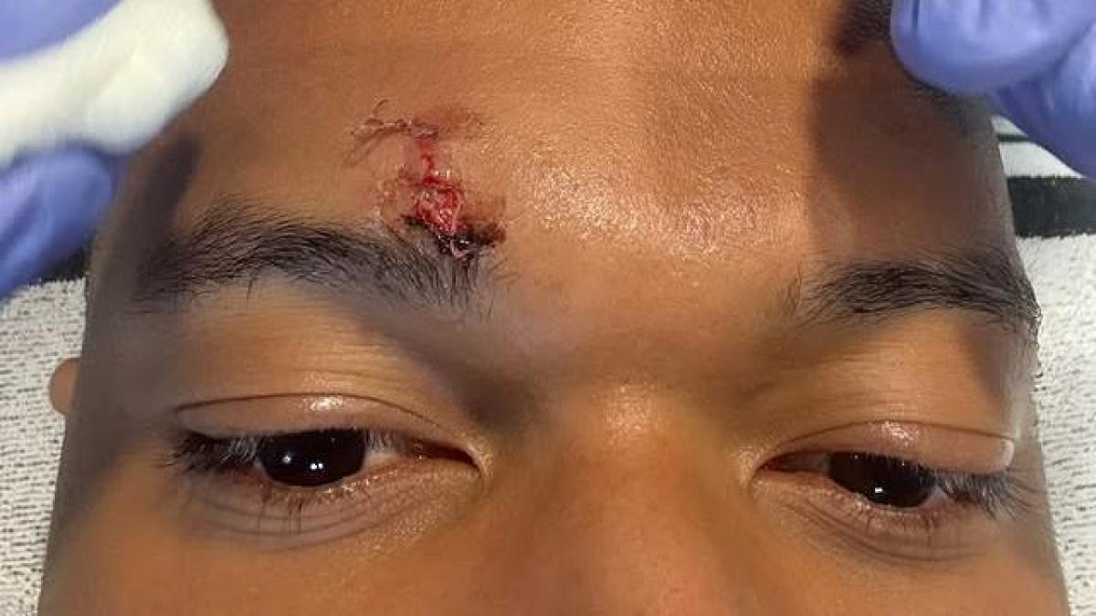 إصابة مبابي